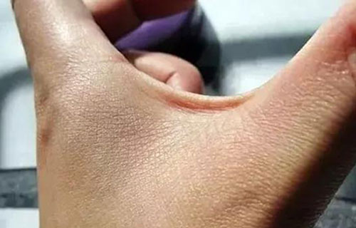 肝脏是“沉默”的，如果手上出现这5个特征，那是肝脏在呼救！
