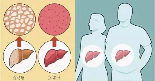 脂肪肝、酒精肝......为什么肝病开始“招惹”年轻人？