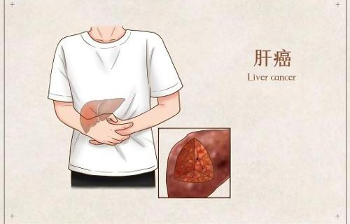 为什么肝功能正常，却还是得了肝癌？听专家怎么说