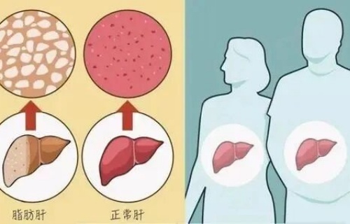 肝胆一点通⑨|认识脂肪肝:别拿肝脏“发福”不当回事!