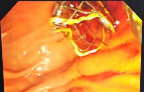 品质医疗|多学科协作+ERCP,71岁黄疸患者解除“胆道危机”!